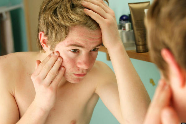 Descobrem a verdadeira causa do acne