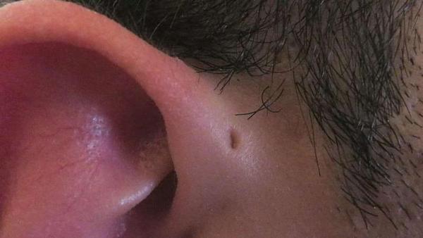 Por que algumas pessoas têm este curioso buraco em suas orelhas?