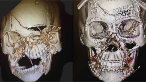 Impressionante imagem de um crânio após uma reconstrução facial